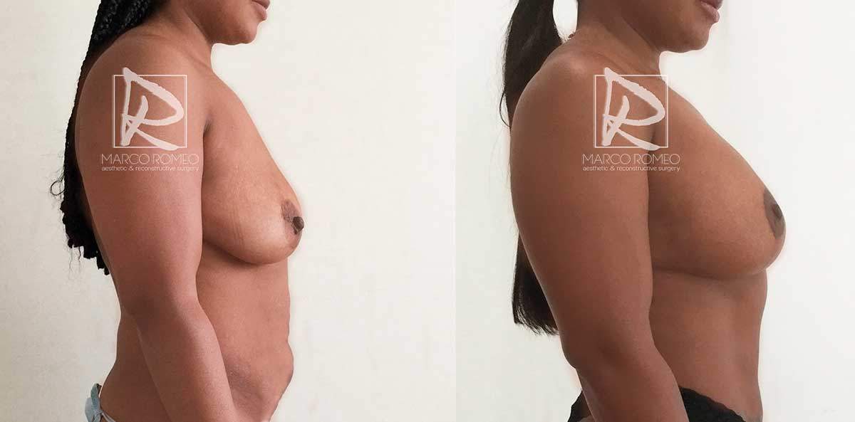 Mommy Makeover - Right side- Dr Marco Romeo