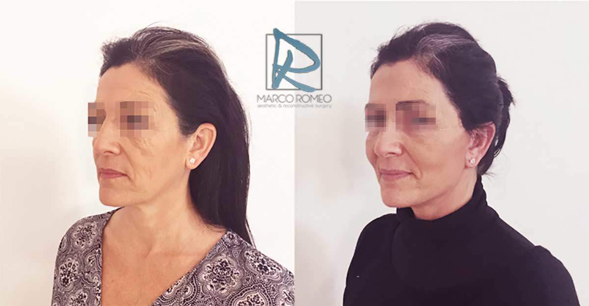 Face Lift - Case 90000 - Left Angle - Dr Marco Romeo