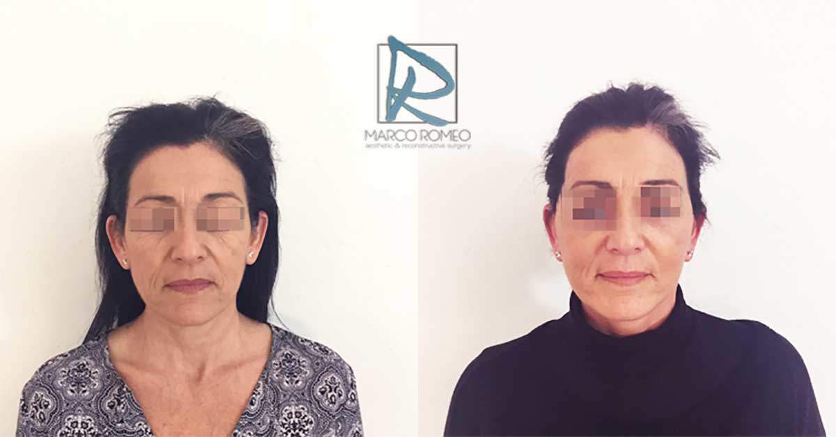 Face Lift - Case 90000 - Front - Dr Marco Romeo
