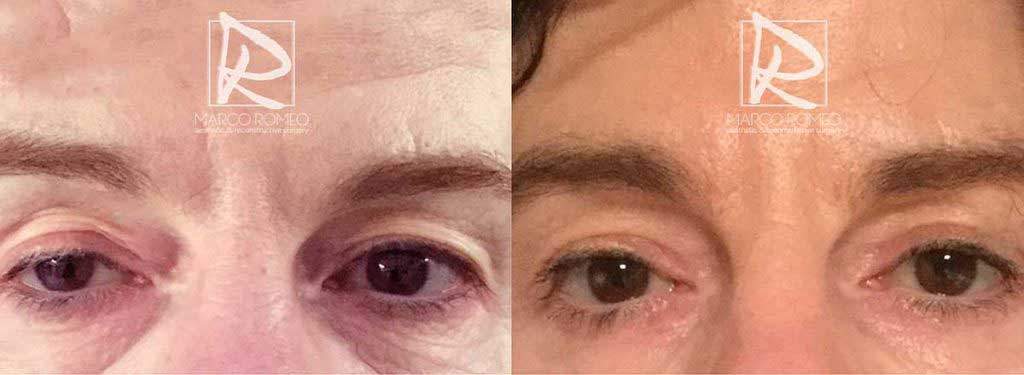 Upper Eyelid Surgery & Unilateral Congenital Ptosis - Open eyes - Dr Marco Romeo