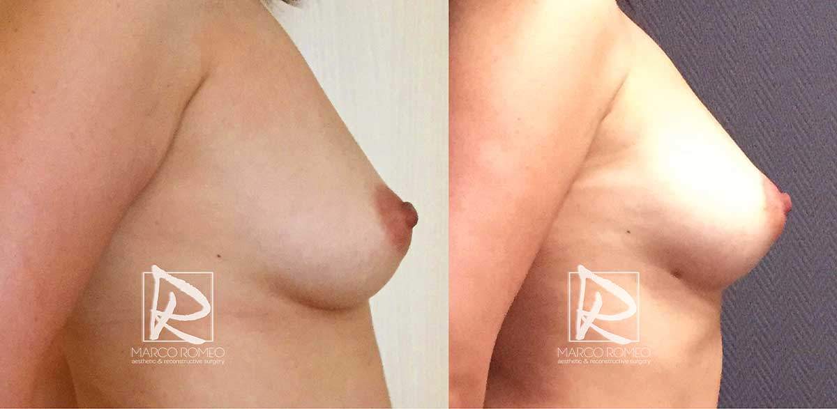 Breast Augmentation - Right Side - Dr Marco Romeo