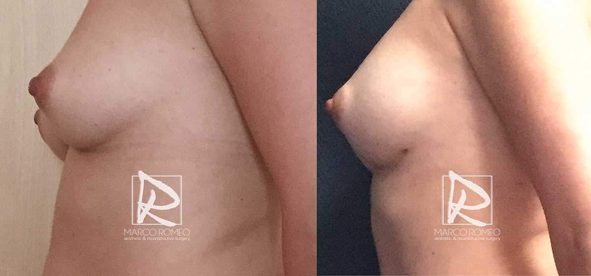 Breast Augmentation - Left Side - Dr Marco Romeo