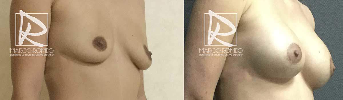 Aumento Mamario 5200 - Ángulo Derecho - Dr Marco Romeo