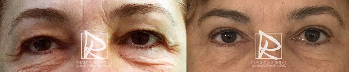Blefaroplastia - Antes y Después - Frente Ojos Abiertos - Dr Marco Romeo