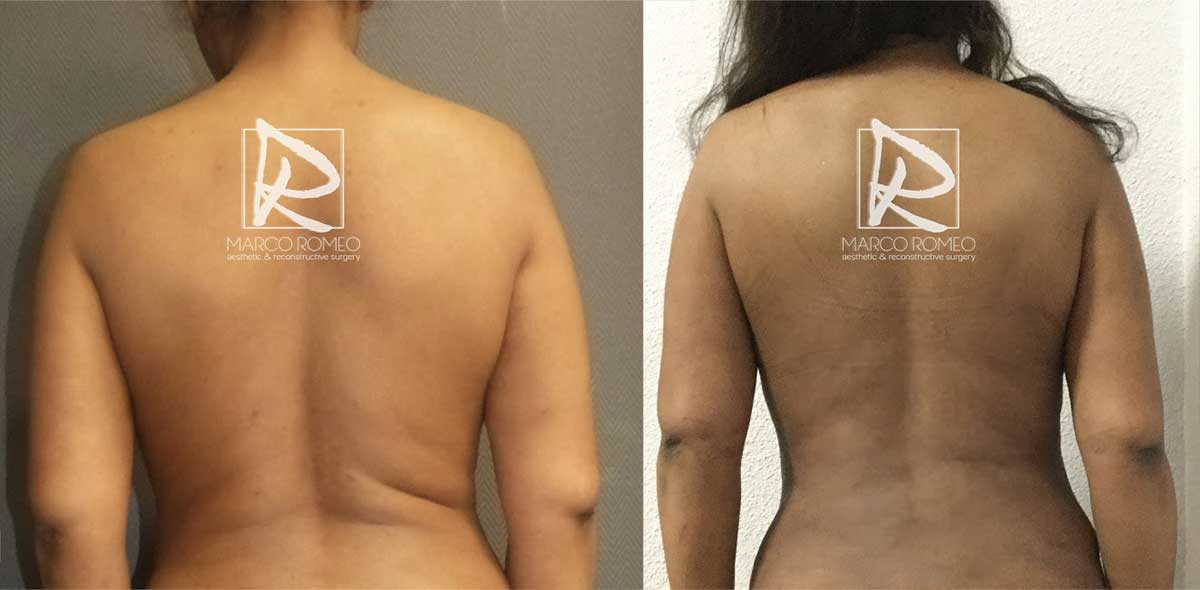 Mommy Makeover - Before and After - Back - Dr Marco Romeo