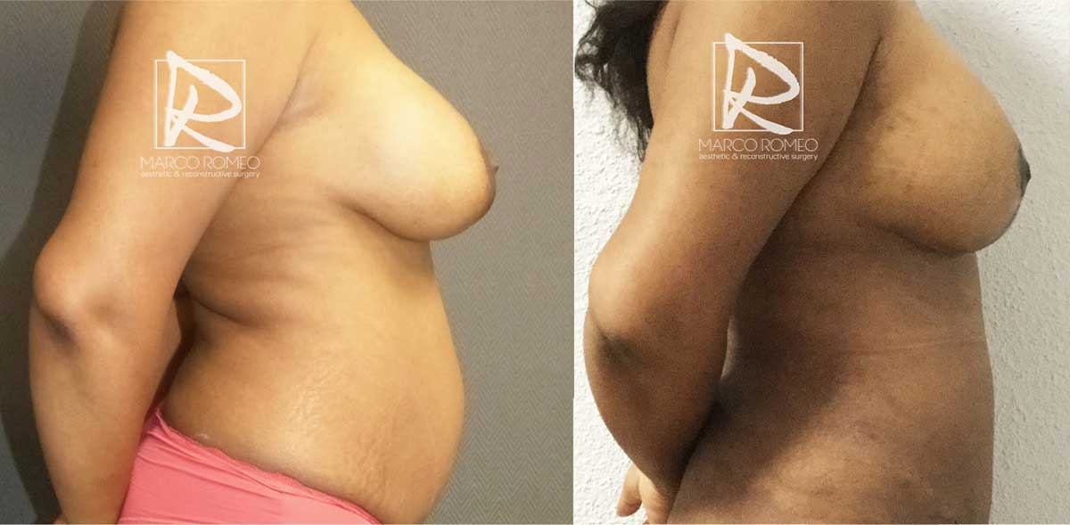 Mommy Makeover - Before and After - Right Side - Dr Marco Romeo