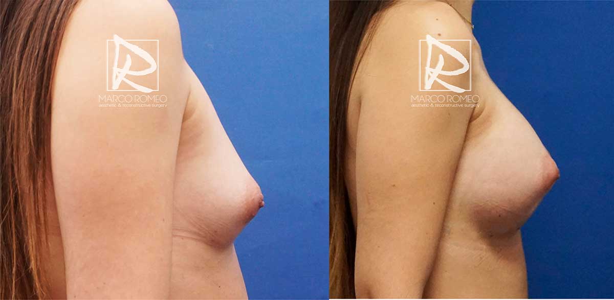 Aumento mamario lado derecho - dr marco romeo