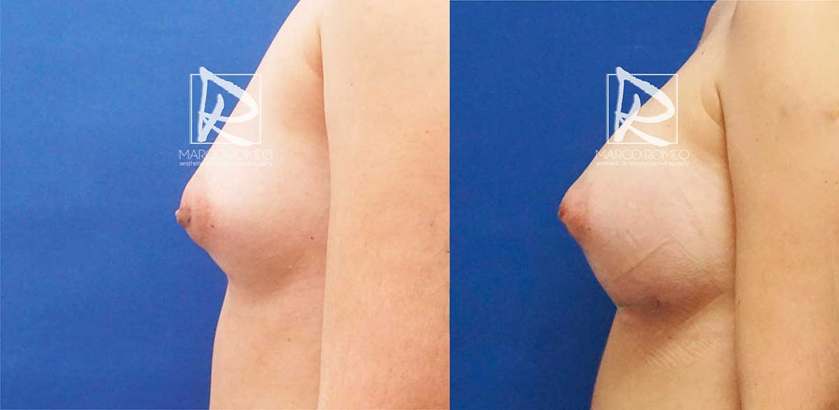 Aumento mamario lado izquierdo - dr marco romeo